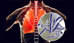 Explore the journey of Legionnaires' disease from a mysterious illness to a recognized epidemic.
